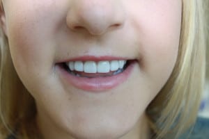 teeth-after-veneers